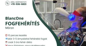 Fogfehérítés Móron, a Dr. Böjte Fogorvosi Rendelőben