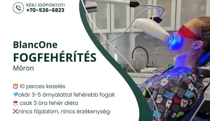 Fogfehérítés Móron, a Dr. Böjte Fogorvosi Rendelőben
